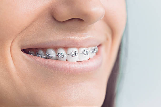 Best Traditional Braces  in USA